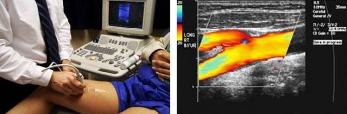 روش انجام تصویر از مسیر سیاهرگ های واریسی به کمک سونوگرافی