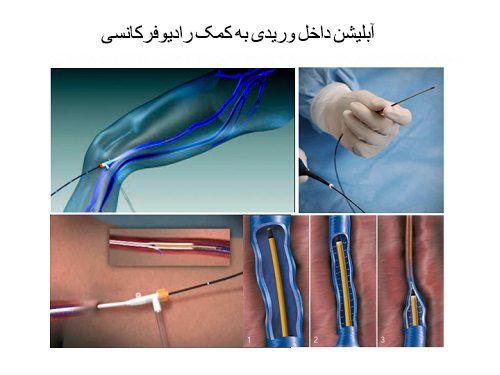 درمان ابلیشن داخل وریدی