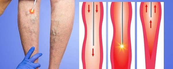 درمان رگ‌های واریسی با لیزر