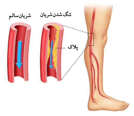  نکاتی درباره آنژیوپلاستی شریان‌های پا