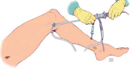 Varicose Vein Surgery for the Treatment of Varicose Veins and