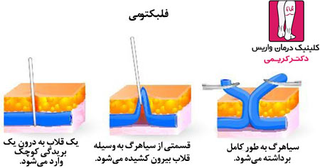 روش انجام فلبکتومی سرپایی