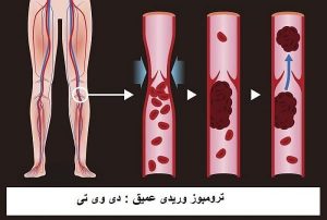 ترومبوز وریدیی عمیق (DVT)