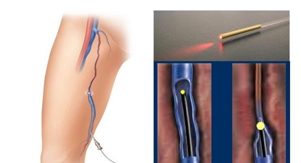 درمان واریس با امواج رادیویی و لیزر