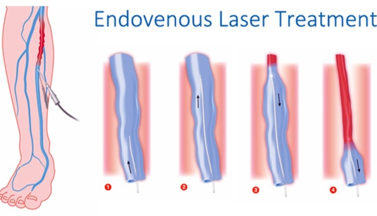 درمان واریس با لیزر