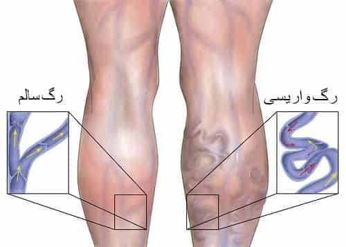 درمان واریس با زالو