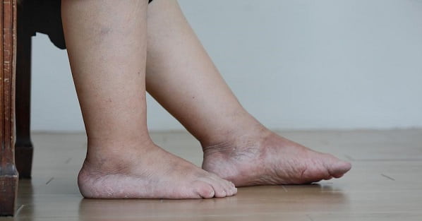 علت تورم پاها چیست؟